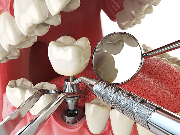 Best Emergency Wisdom Teeth Removal in Westville, IN